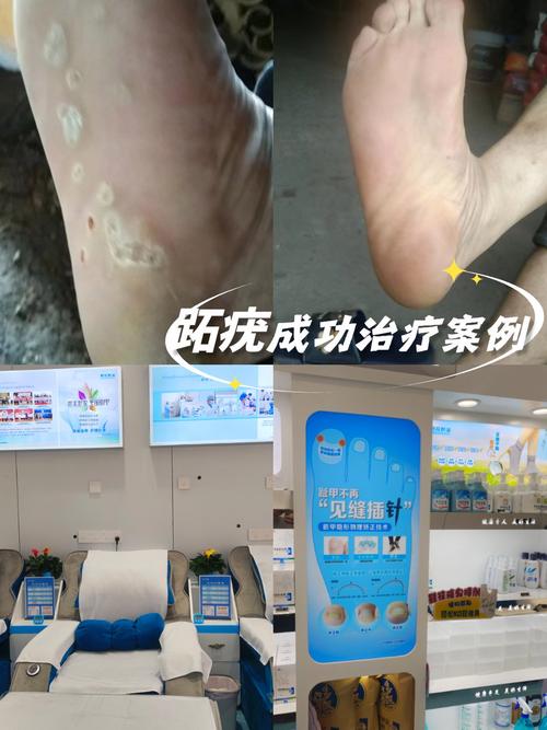 针灸能够治疗跖疣吗