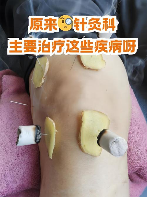 针灸能够治疗跖疣吗