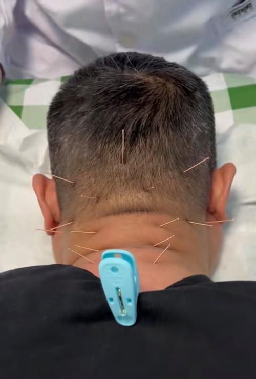 颈椎病针灸治疗进展