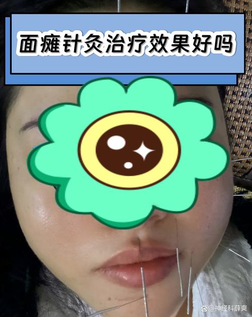 针灸治疗面瘫多少钱