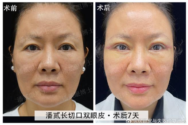 眼皮下垂上海美莱安全