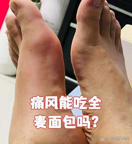 痛风病可以吃面包吗