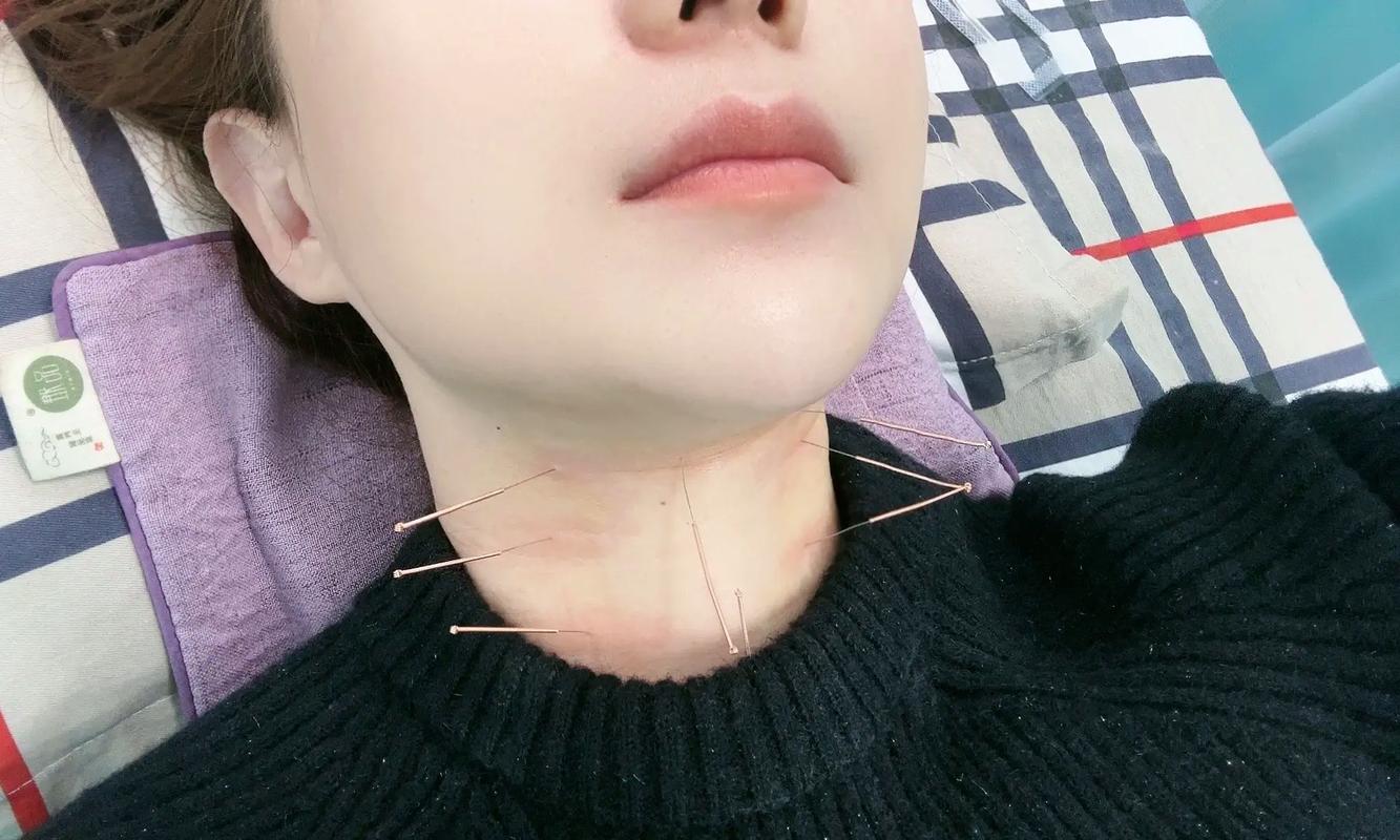 咽喉炎针灸治疗方法