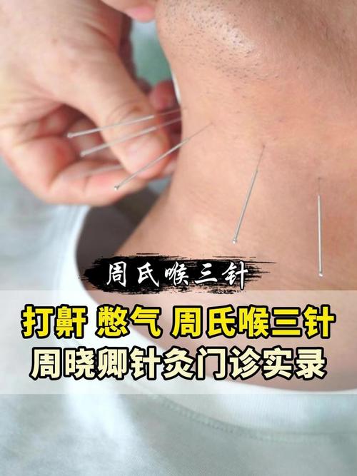 咽喉炎针灸治疗方法