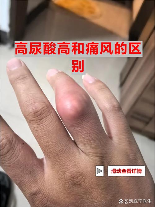 尿酸高一定是痛风么