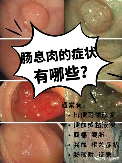 扁平状肠息肉最安全了