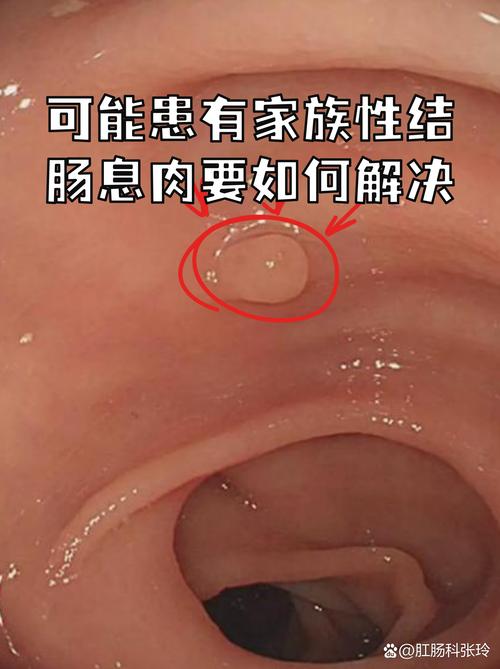 扁平状肠息肉最安全了