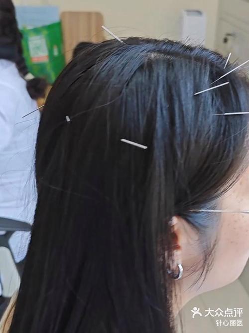 针灸祛斑的效果怎样