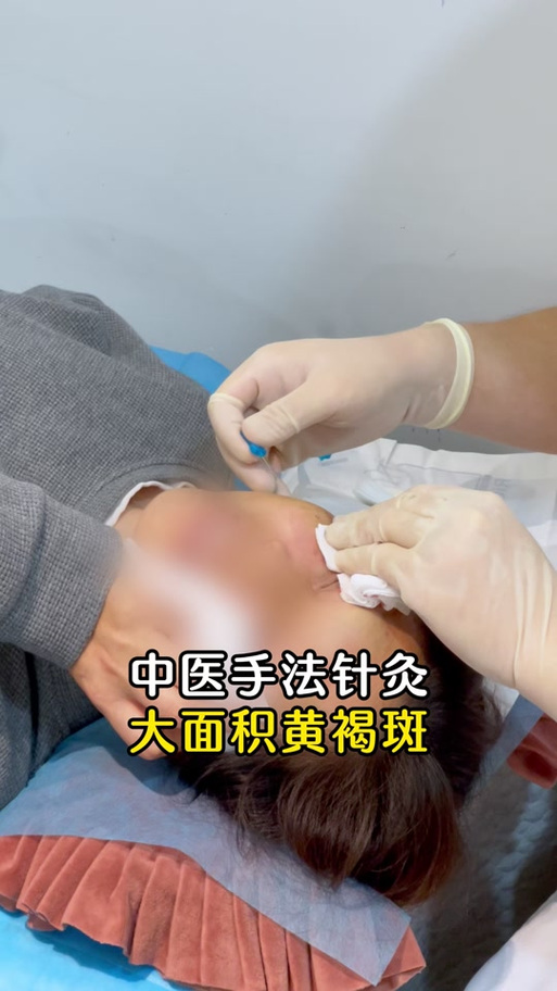 针灸祛斑的效果怎样