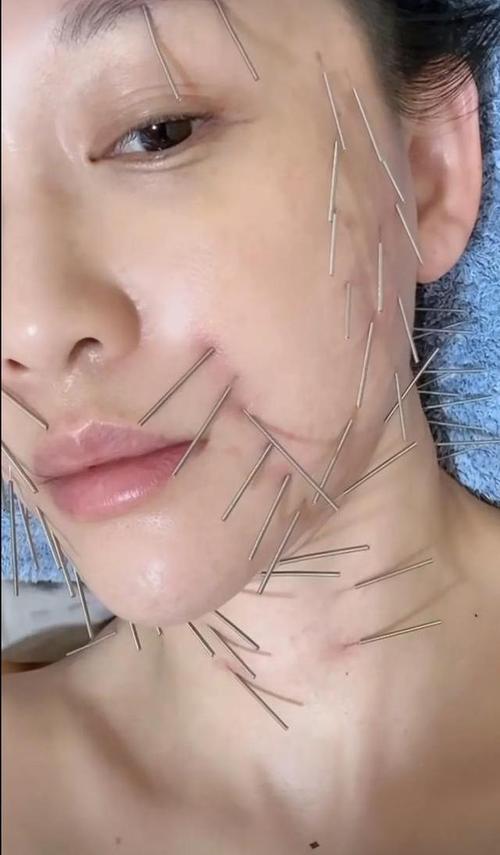 针灸祛斑的效果怎样