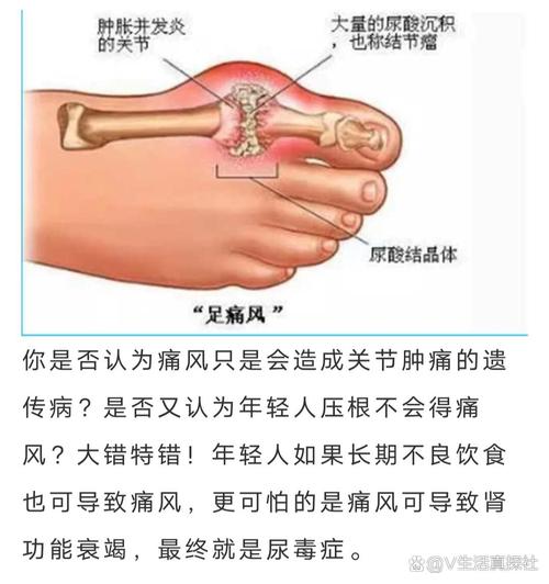 痛风会引起尿毒症吗