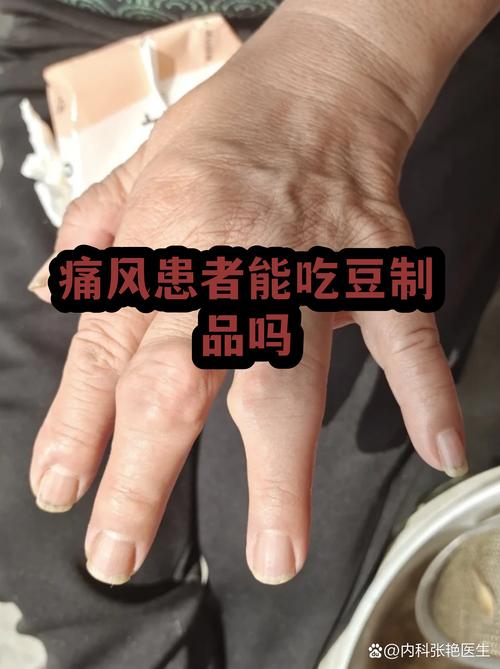 男友有痛风能结婚吗