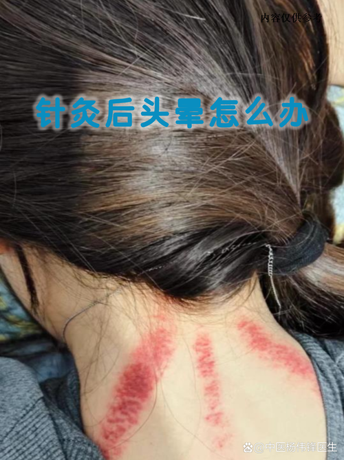 针灸后老放屁为什么