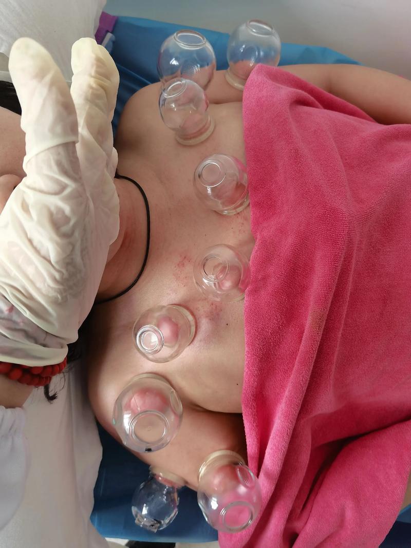 济南针灸丰胸哪家好