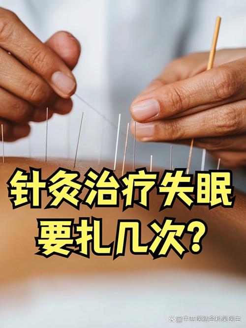 针灸治失眠效果如何