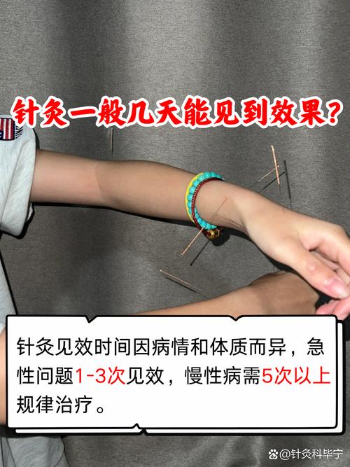 针灸对精子有影响吗