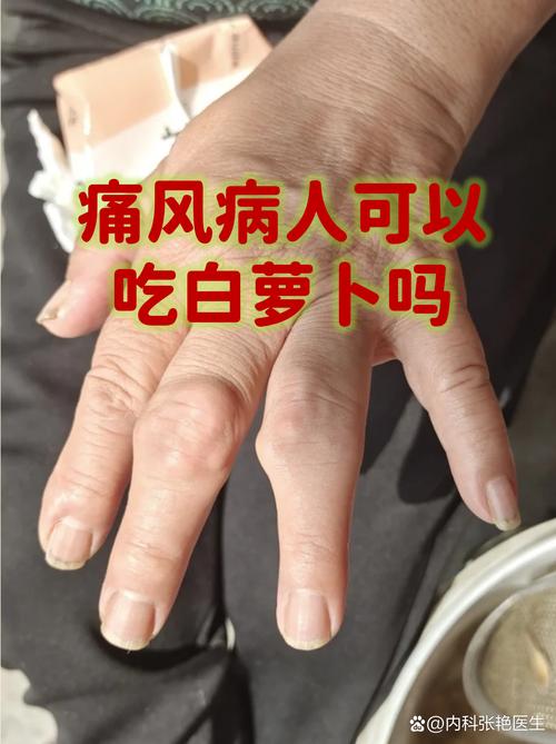 痛风病人能吃醋豆吗