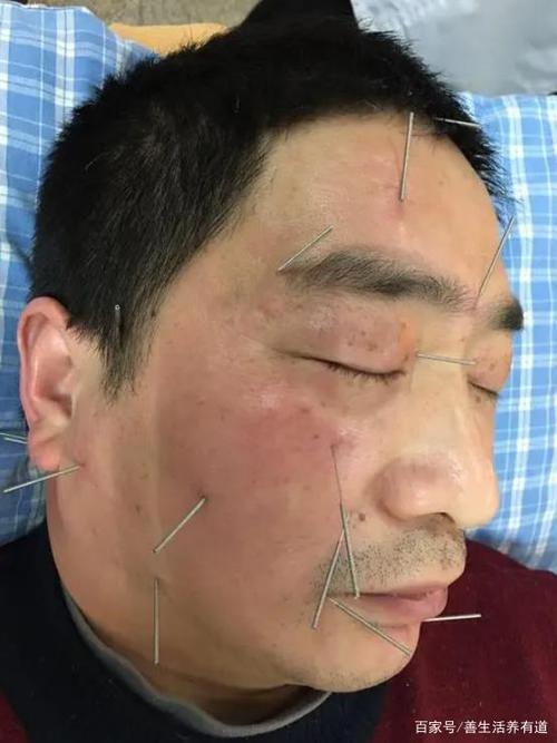 面瘫有没有针灸健侧