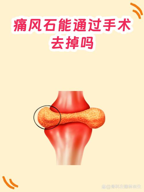 痛风关节镜手术费用