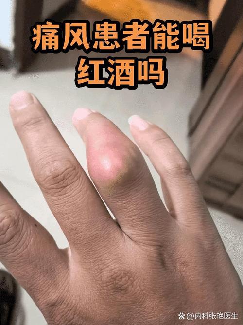 痛风可以喝葡萄酒么