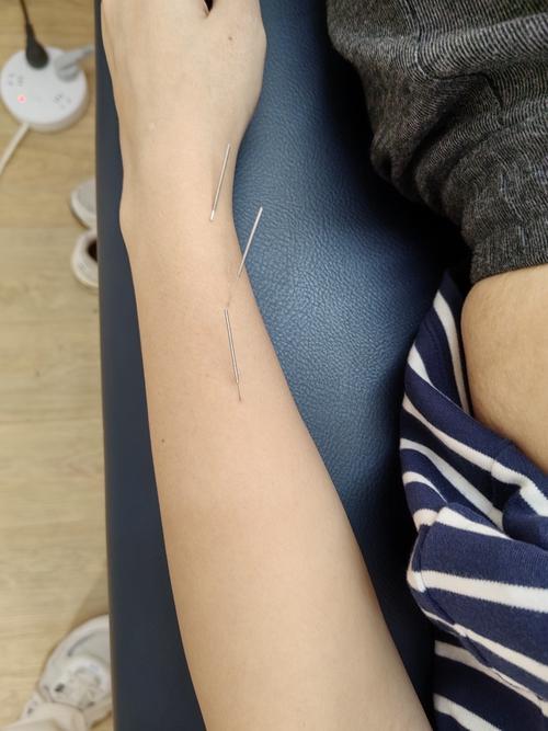 针灸治疗神经末梢炎