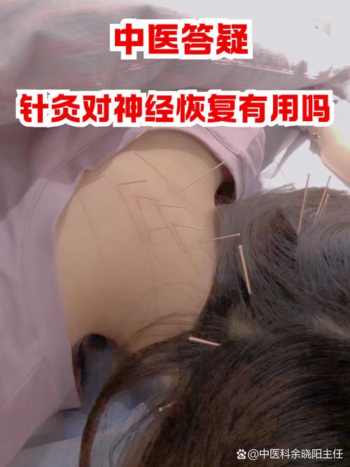 针灸治疗神经末梢炎