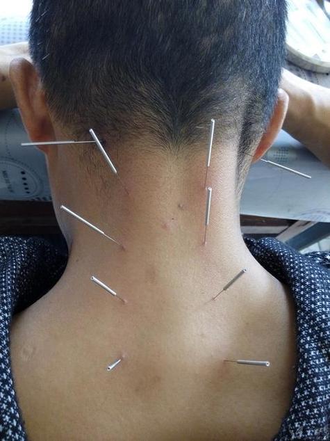 郑州针灸治疗颈椎病