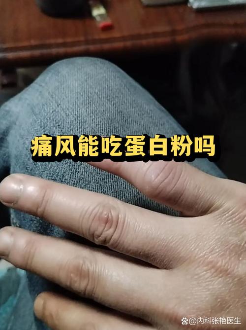 痛风可以吃白砂糖吗