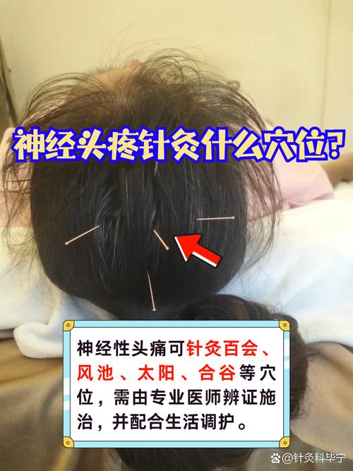 神经性头疼针灸多久