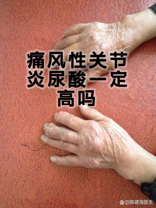 高血尿酸就是痛风吗