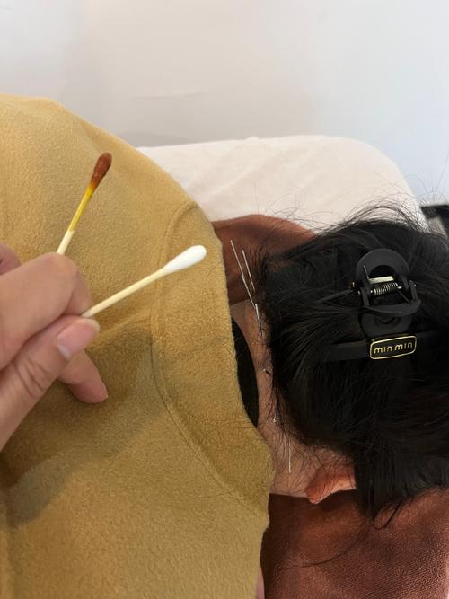 长沙哪里有好的针灸