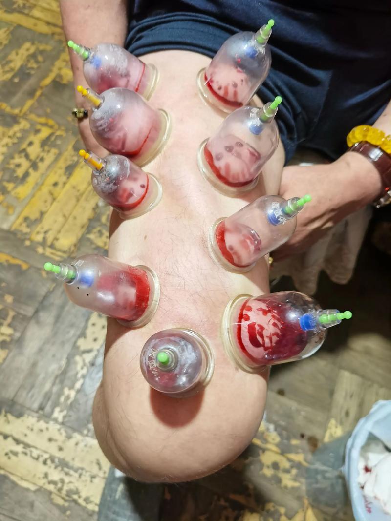 淮南哪里拔罐针灸好