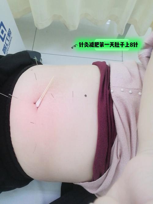 针灸减肥的穴位在哪