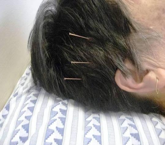 针灸治疗脑外伤失嗅