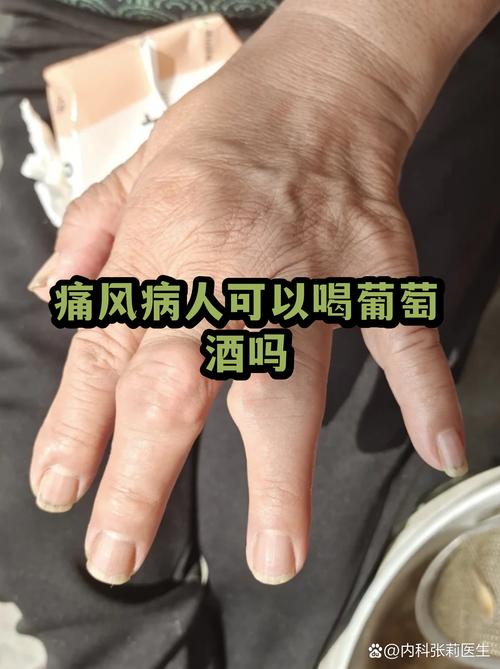 痛风病人能吃棕子吗