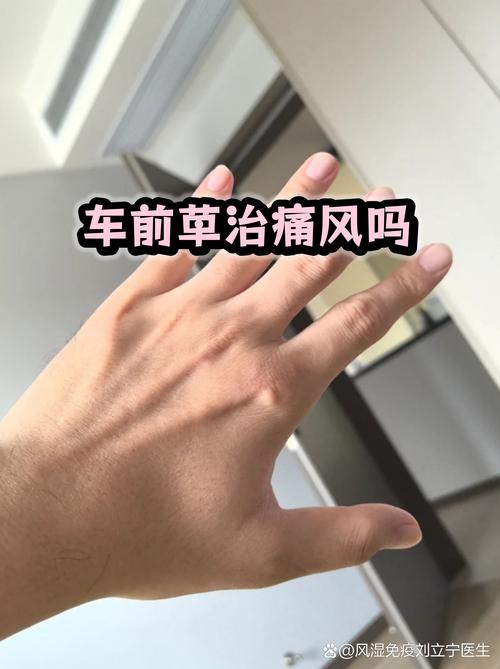 痛风可以用青草膏吗