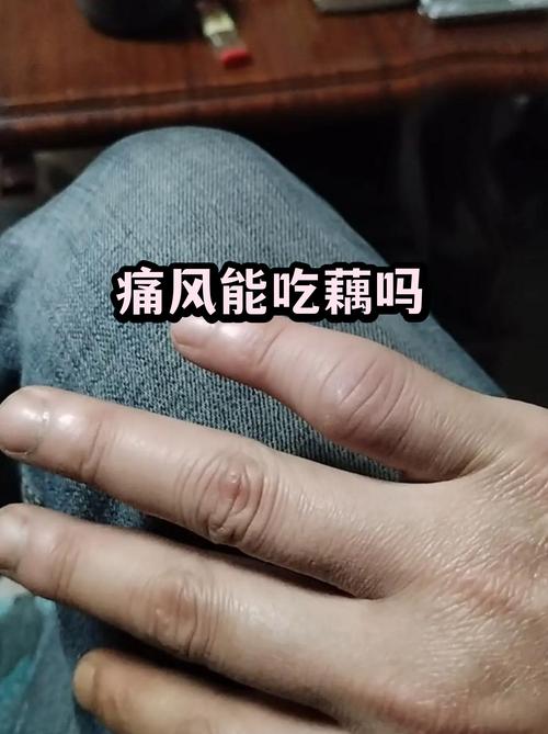 痛风病人可以吃藕吗