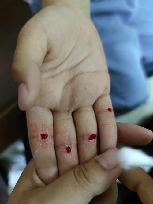 用针灸针治疤痕放血