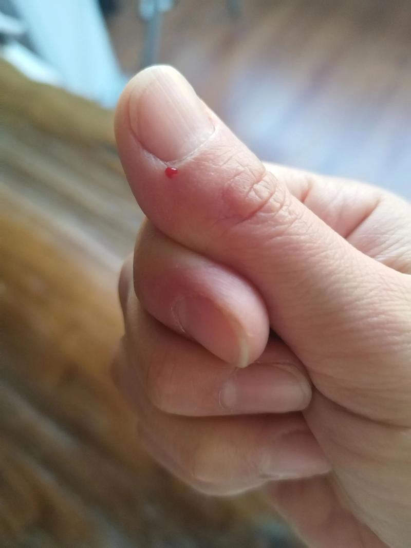 用针灸针治疤痕放血