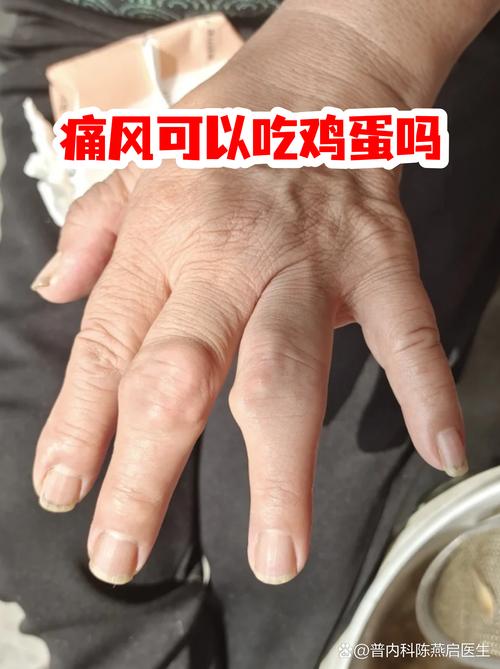 痛风可以吃鸡蛋黄吗