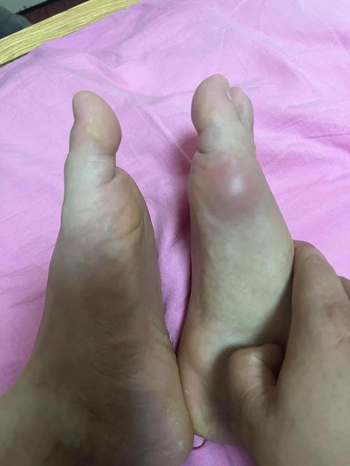 得了脚痛风会怎么样