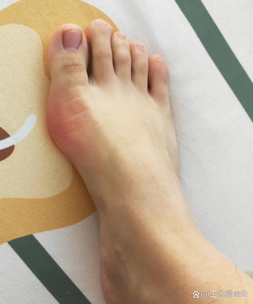 得了脚痛风会怎么样