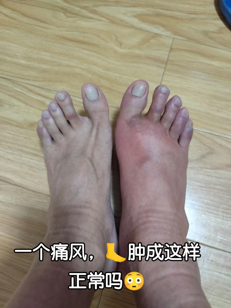 得了脚痛风会怎么样