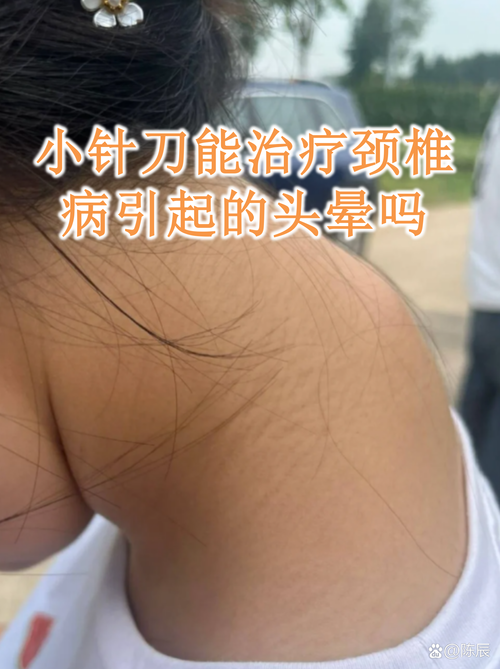颈椎病针灸几天见效