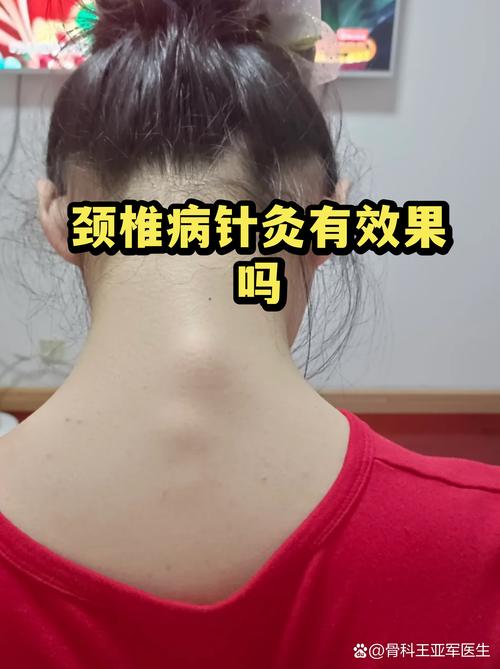 颈椎病针灸几天见效