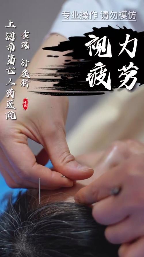 针灸治疗疲劳综合征