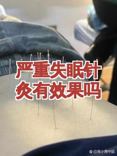 针灸后为什么会失眠