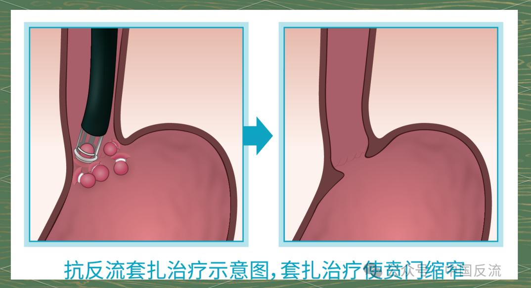 胃食道反流针灸治疗