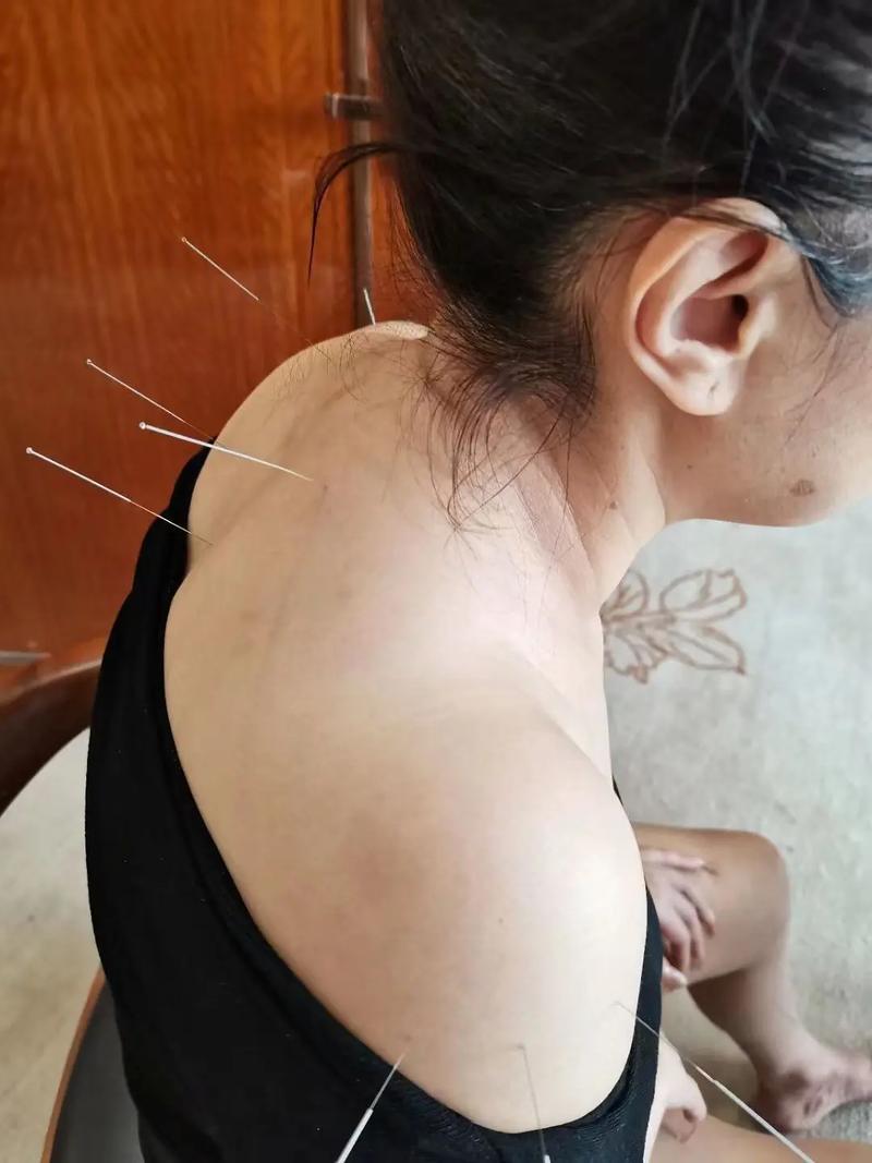 针灸调理身体好不好