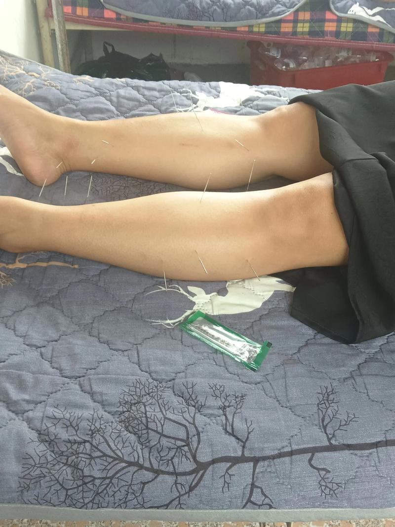 针灸调理身体好不好